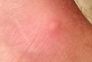 mosquito-bite